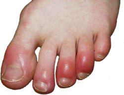 gout pictures big toe #11
