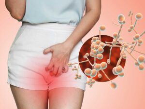 homeopathic medicines for vaginal candidiasis are very effective and can cure the problem completely