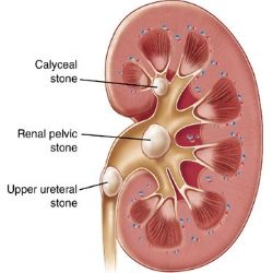 Reckeweg R27 Renal Calculi Drops Dissolves Kidney Stone Naturally