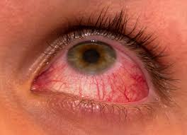 Image result for homeopathic medicines for eye diseases