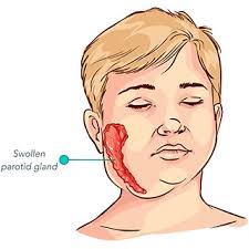 Remedies for mumps natural Home Remedies