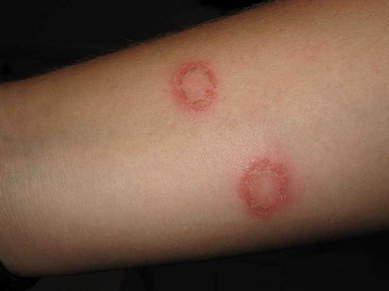 How to manage ringworm in babies and children | BabyCenter