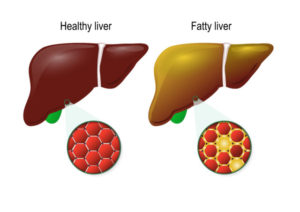Homeopathic medicines for fatty liver are very effective and can cure the problem completely.