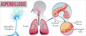 Homeopathic medicines for aspergillosis are very effective